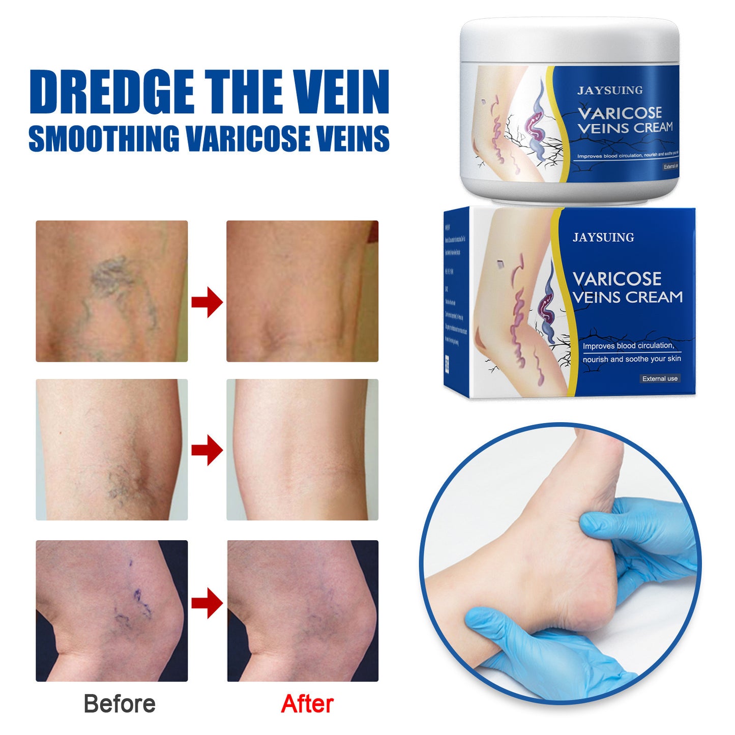 π LAST DAY PROMOTION - 50%OFF π Leg Relief Varicose Veins Cream - JSS6