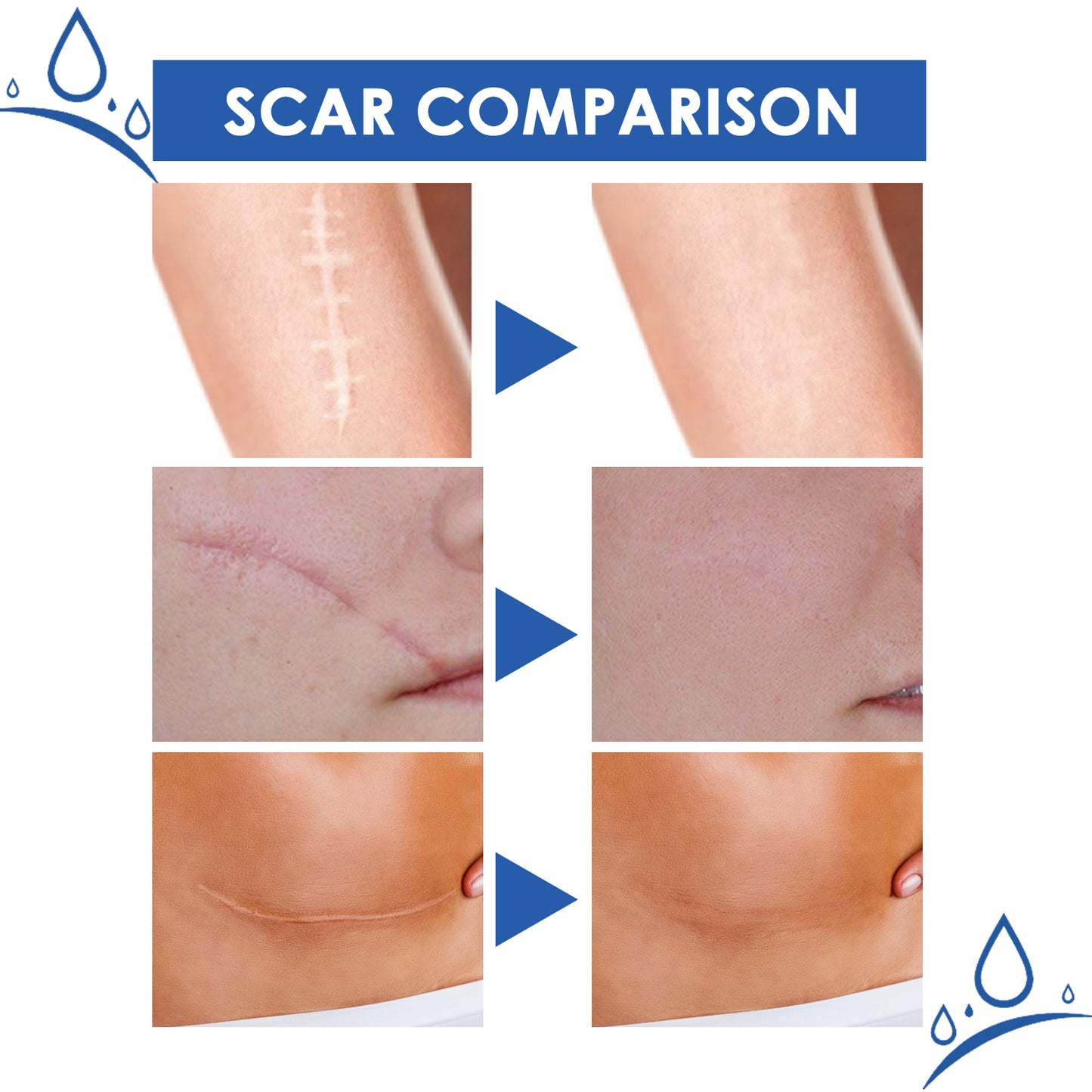 ✨ LAST DAY PROMOTION - 50%OFF✨-Softens and smoothens scars Scar Cream-ABB8