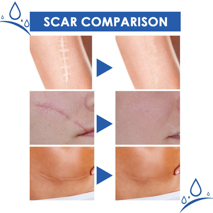 ✨ LAST DAY PROMOTION - 50%OFF✨-Softens and smoothens scars Scar Cream-ABB8
